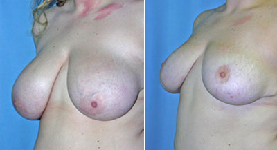 Breast Reduction surgery