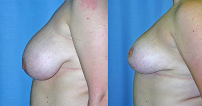Breast Reduction surgery