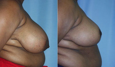 Breast Reduction surgery