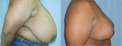 breast reduction surgery photos
