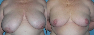 Breast Reduction surgery