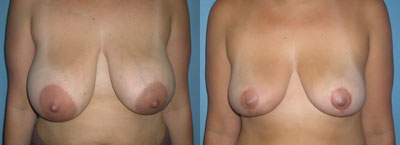 Breast Reduction surgery