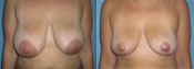 breast reduction surgery photos