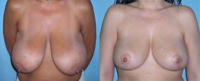 Breast Reduction surgery