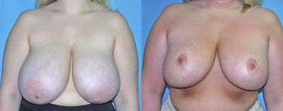 Breast Reduction surgery