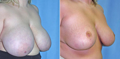 Breast Reduction surgery