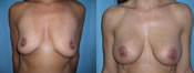 breast implant surgery