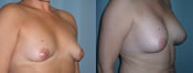 breast implant surgery