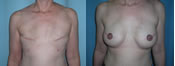 Breast Reconstruction Photos