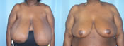 breast reduction surgery photos