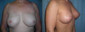 breast reduction surgery photos