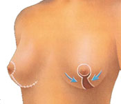 Breast lift diagram