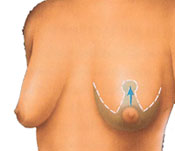 Breast lift diagram