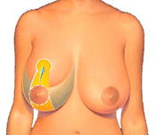 Breast Reduction Diagram