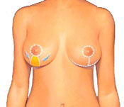 Breast lift diagram