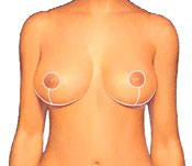 Breast Reduction Diagram