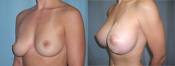breast implant surger