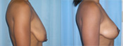 breast lift surgery photos